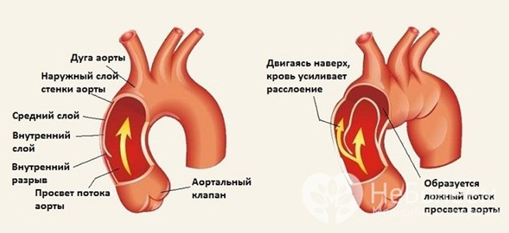 Расслоение аневризмы аорты